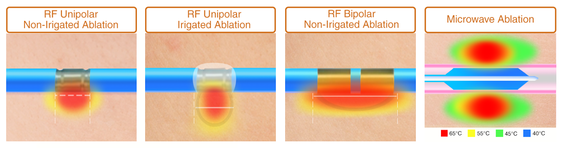 Microwave vs. RF Heating from Symple Surgical Inc.