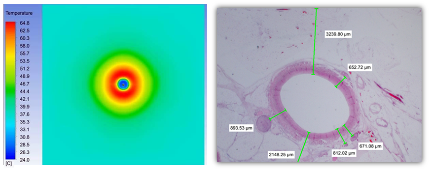 Using thermal simulation and laboratory testing, Symple Surgical optimizes the DirectAblate Renal Denervation System™ and delivers therapeutic microwave energy to Sympathetic Nerves.